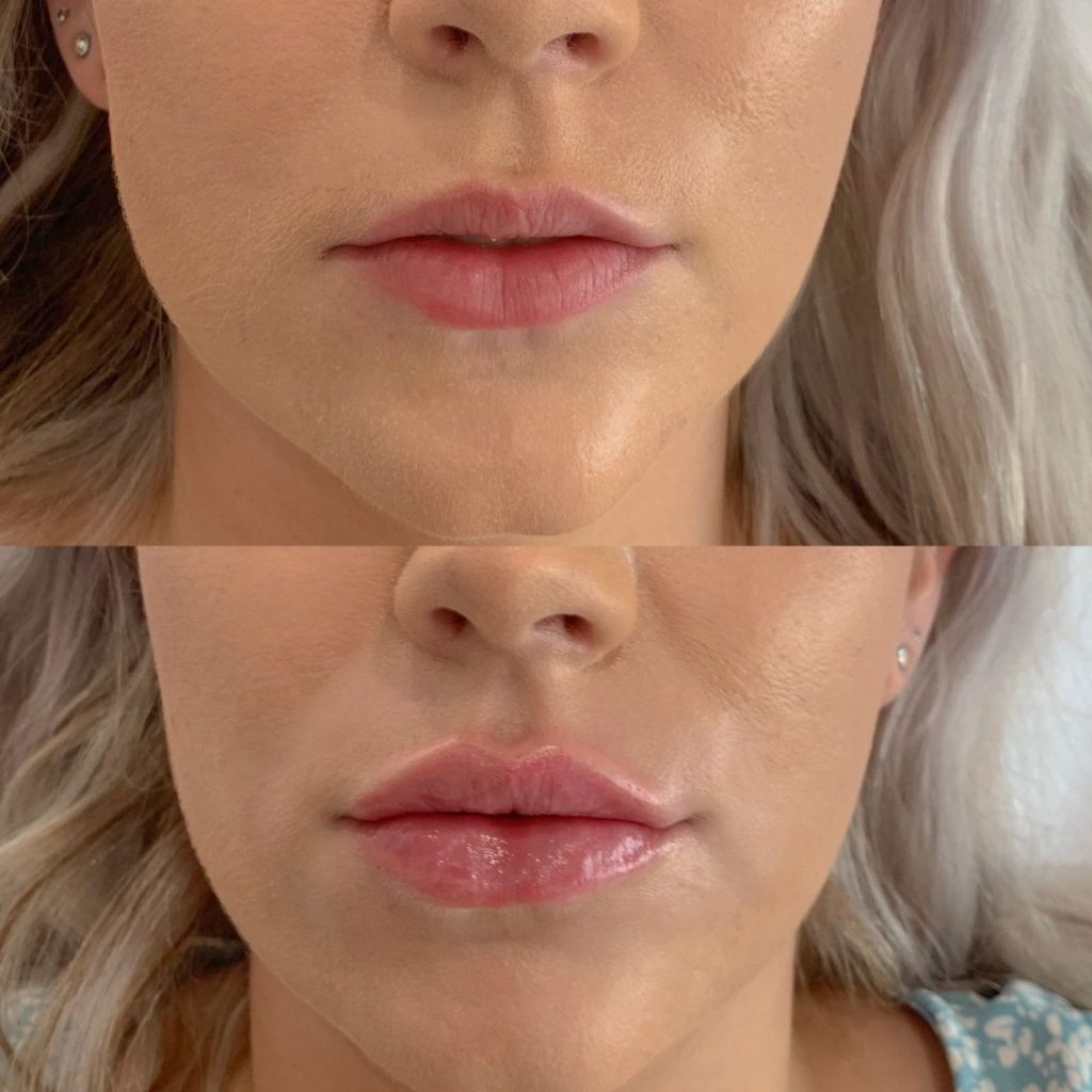 BEFORE AND AFTER LIP FILLER