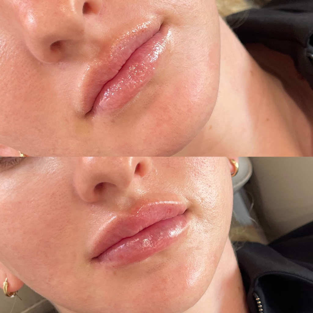 BEFORE AND AFTER LIP FILLER