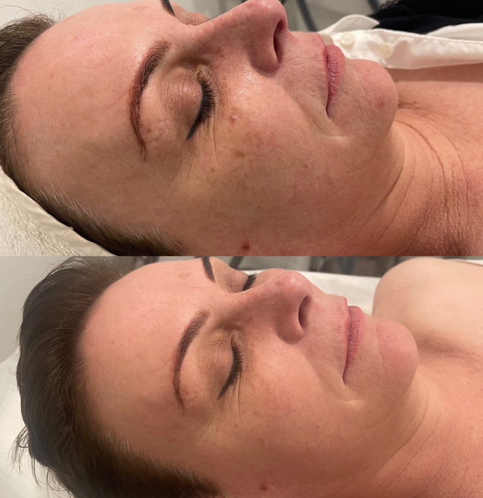 BEFORE AND AFTER SKIN TREATMENTS