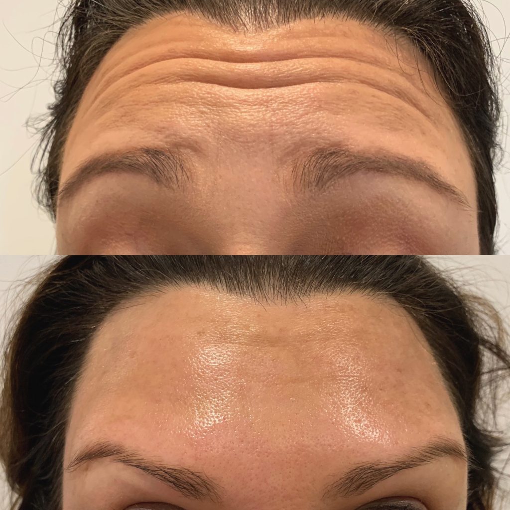 BEFORE AND AFTER ANTI WRINKLE INJECTIONS
