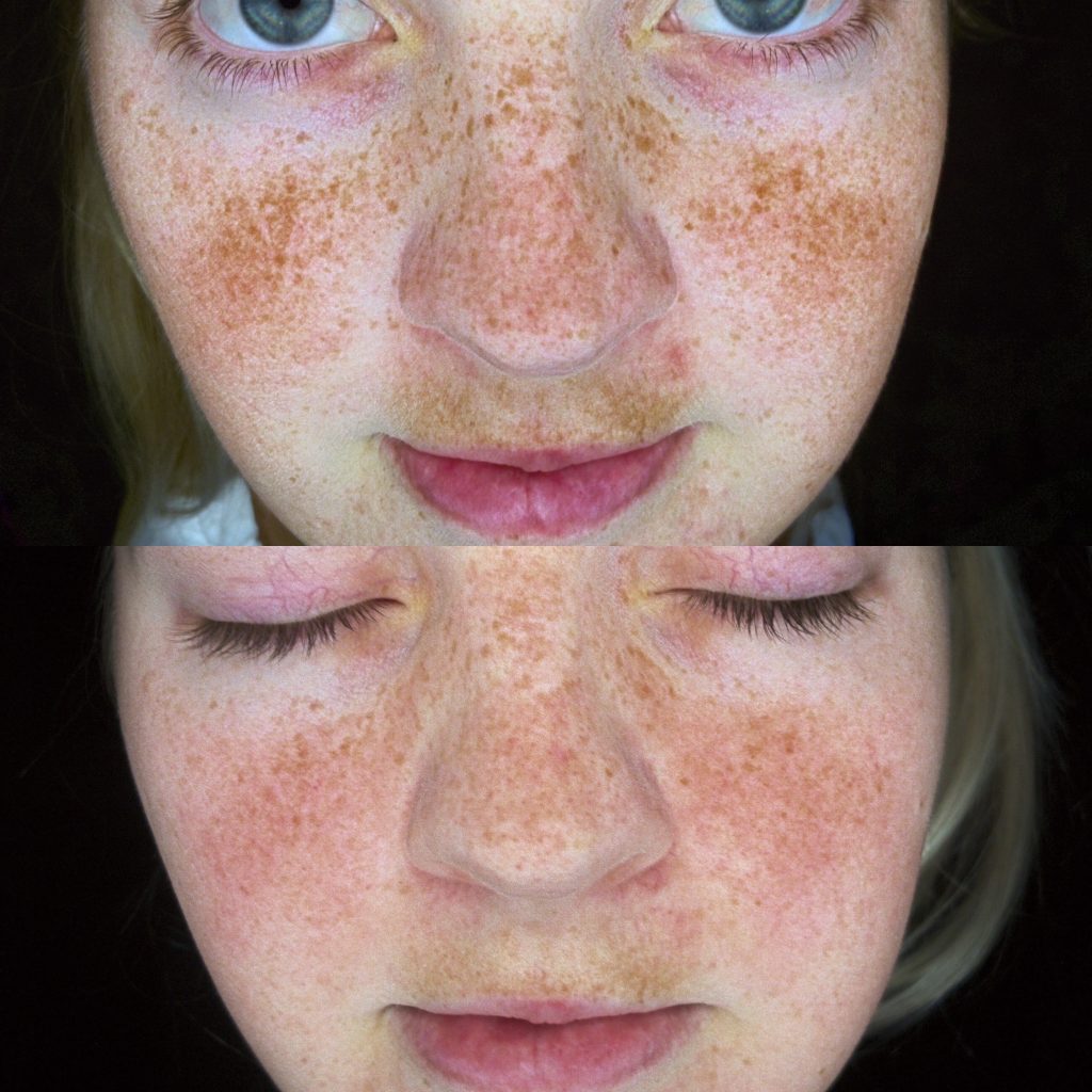BEFORE AND AFTER SKIN TREATMENTS